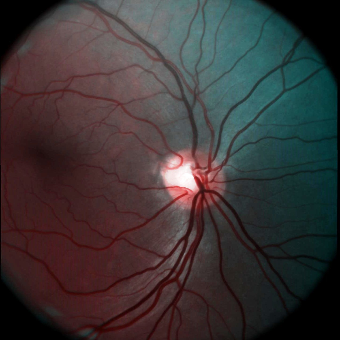 demcon-focal-case-diagnosing of blinding diseases