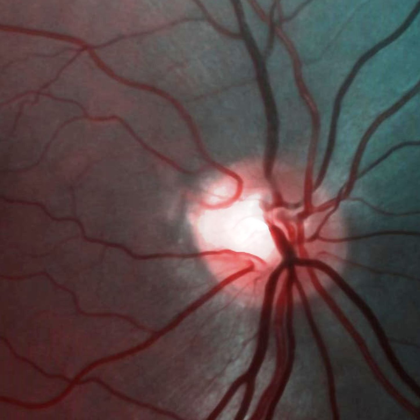 demcon-focal-case-diagnosing of blinding diseases