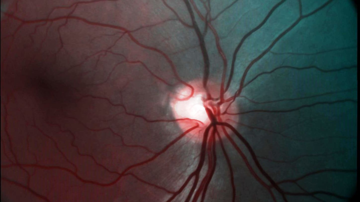 demcon-focal-case-diagnosing of blinding diseases